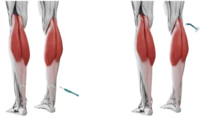 Hielspooroperatie Gastroc Slide (verlenging kuitspier) kan op twee manier worden uitgevoerd: boven de enkel of in de knieholte